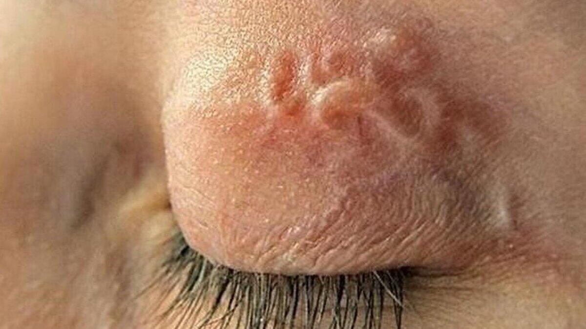 In der Region Charkiw wurde bei einer Frau ein 9,5 Zentimeter langer Parasit aus dem Auge entfernt.